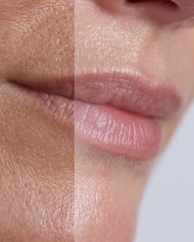 Fillers — lepper